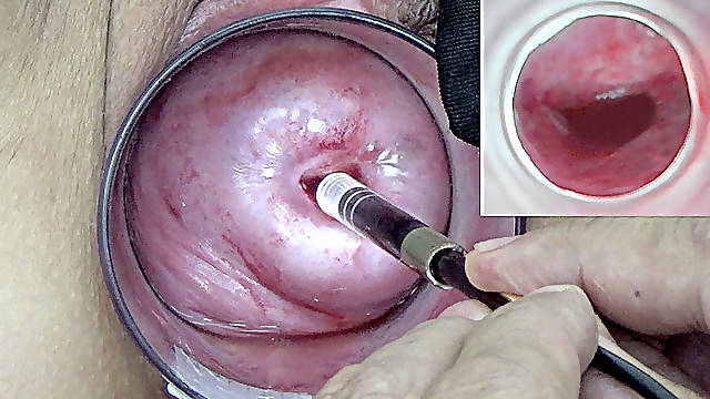 A endoscope japanese camera is inserted in the cervix to watch inside the uterus.